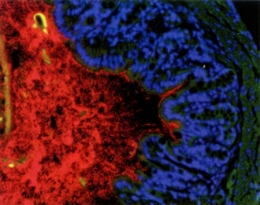 cancer,chimiothérapie,microbiote intestinal,flore intestinale