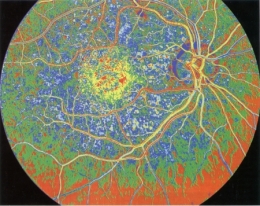 cellules souches,cellules souches embryonnaires,médecine régénératrice,rétine,thérapie