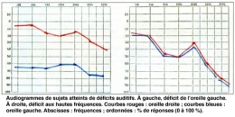 Figure04-audiogramme-450.jpg