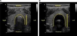 Airway Echo.jpg