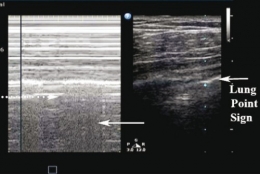 Pneumothorax_Images PasNormales3.jpg