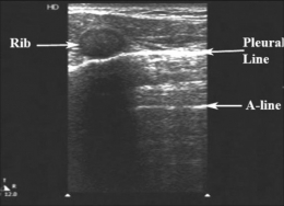 Pneumothorax_Images PasNormales2.jpg