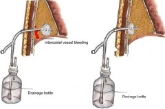 Ffoley Thorax.JPG