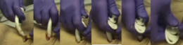 Crico Rotation Canule.png