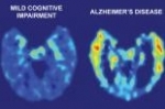 alzheimer.jpg