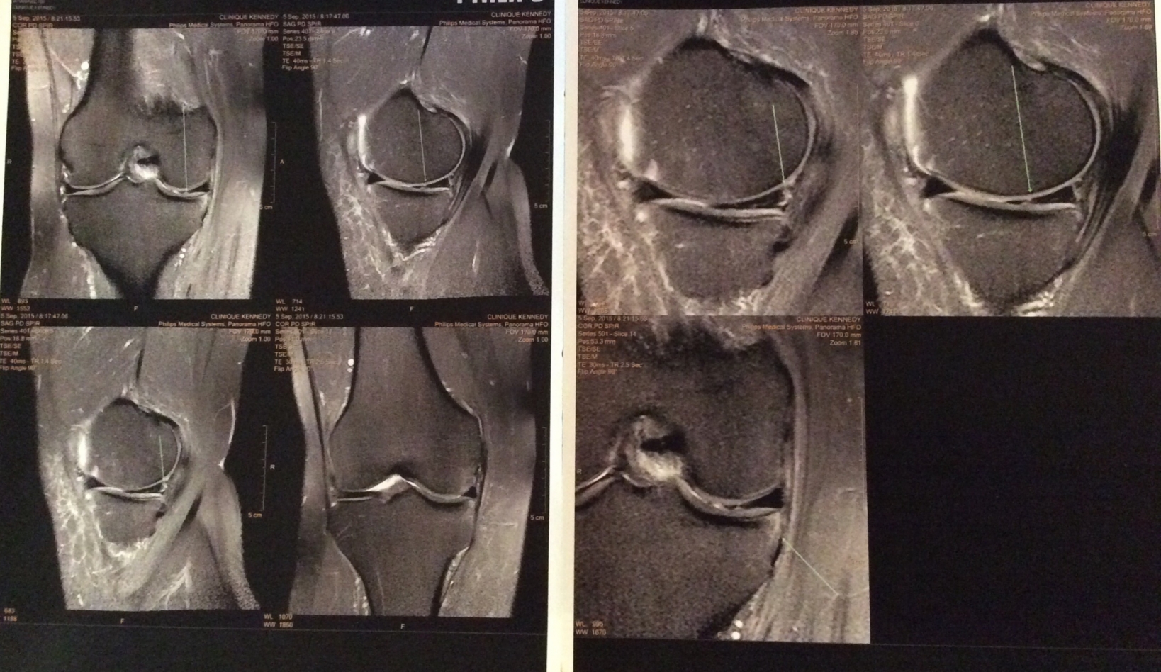 Oedème intraosseux du genou intérêt de l