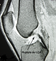 ligaments croisés,rupture