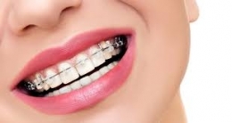 solution malocclusion.jpg