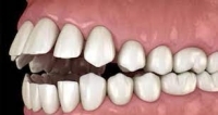 malocclusion dentaire.jpg