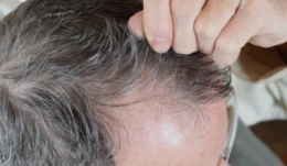 greffe cheveux gris.jpg