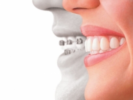 malocclusion traitement.jpg
