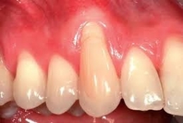 recession gingivale.jpg