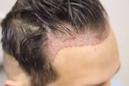 greffe cheveux.jpg